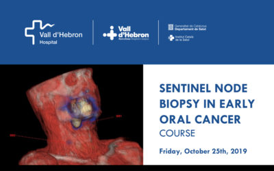 Sentinel node biopsy in early oral cancer