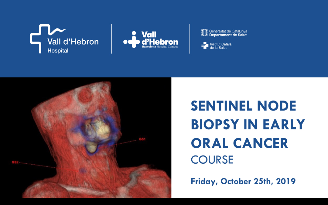 Sentinel node biopsy in early oral cancer
